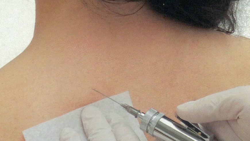 Schmerztherapie mit medizinischem CO2-Gas, Carboxytherapie, Injektion