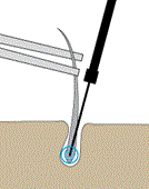 Permanente Haarentfernung durch Nadelepilation, Elektroepilation auch für Transgender, Trans-Frau oder Trans-Mann Elektroepilation, Nadelepilation, permanente Haarentfernung